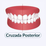 Cruzada posterior