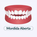 Mordida Aberta