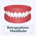 Retrognatismo Mandibular