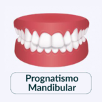 prognatismo Mandibular